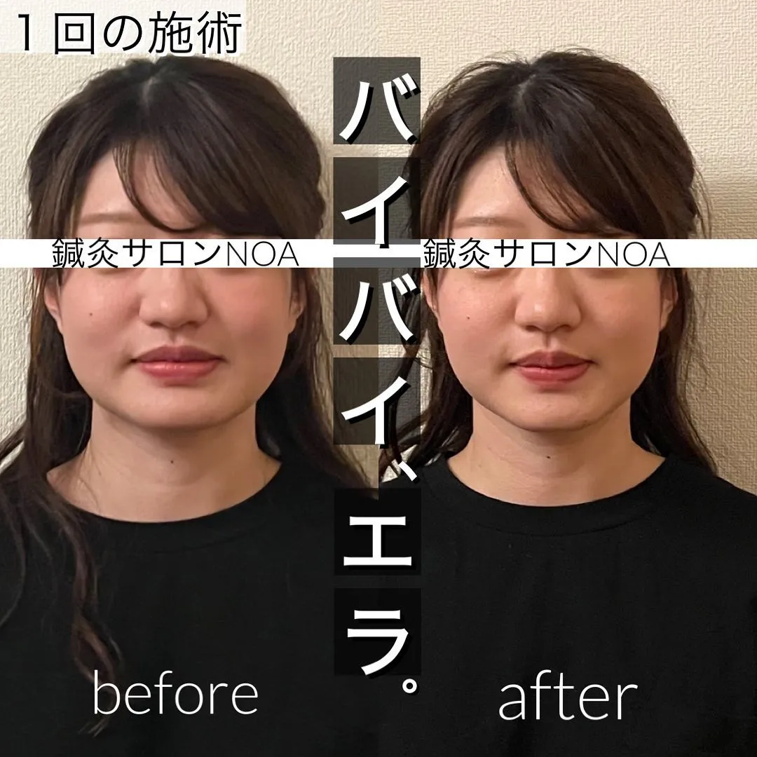 小顔矯正＋美容鍼　初めての施術