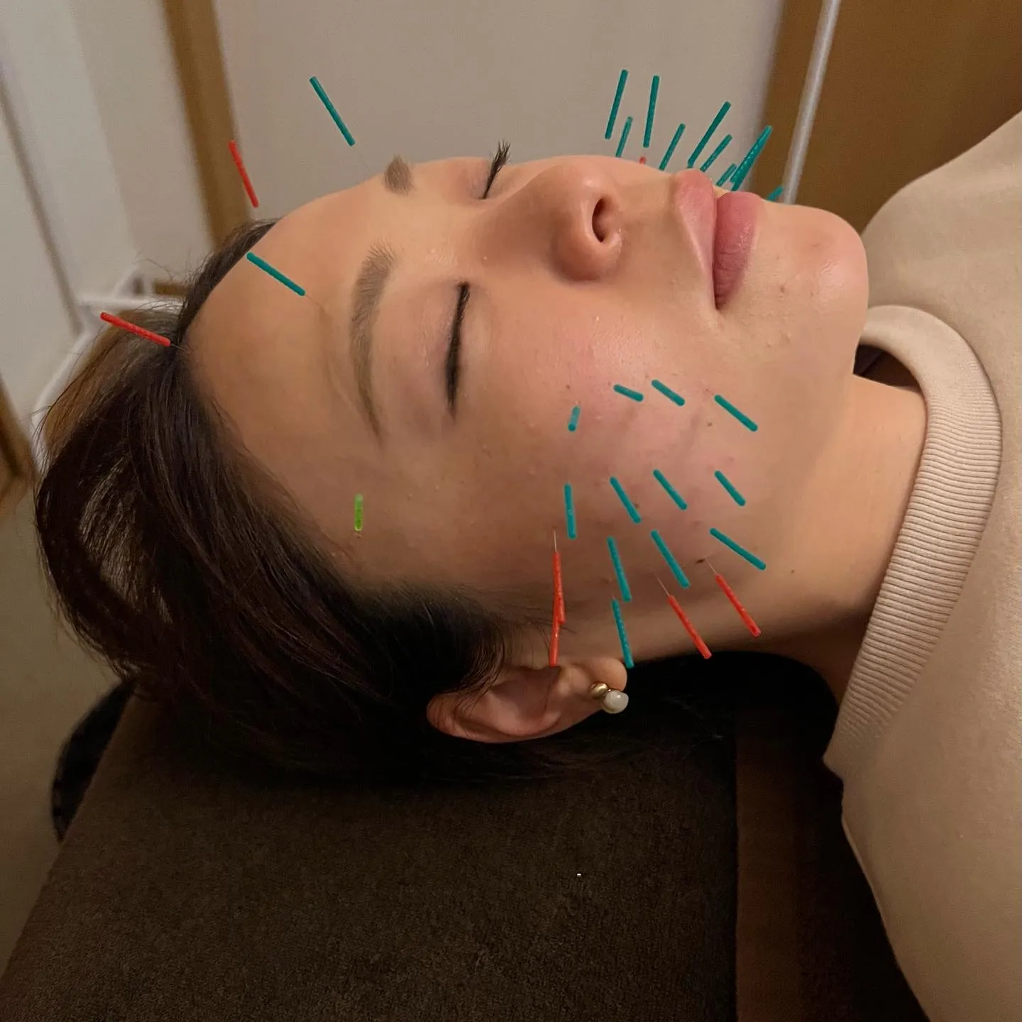 美容鍼でリフトアップ！