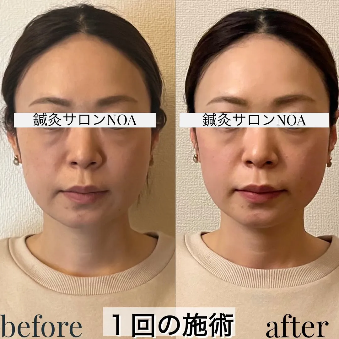 小顔矯正＋美容鍼の効果