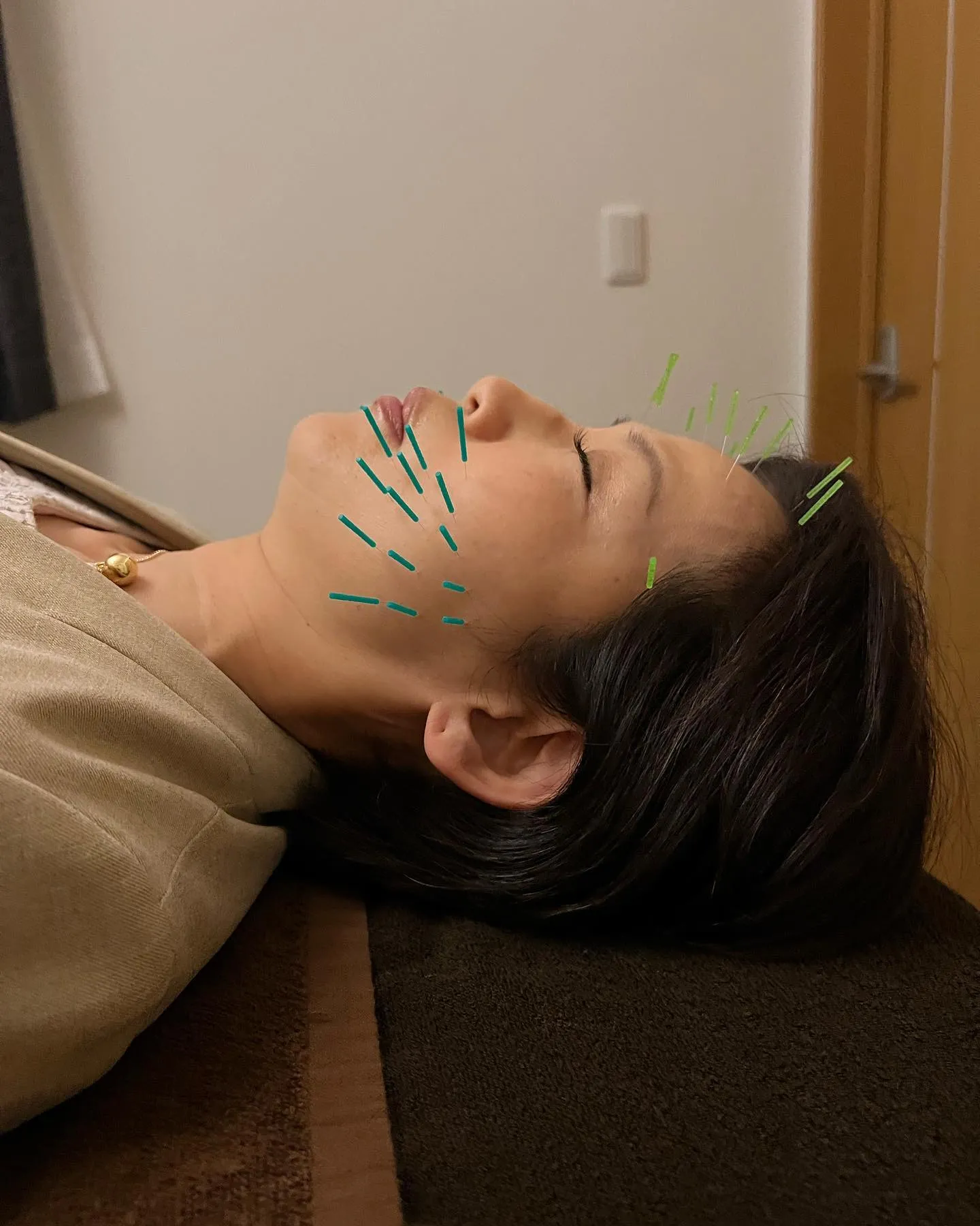 前橋美容鍼施術