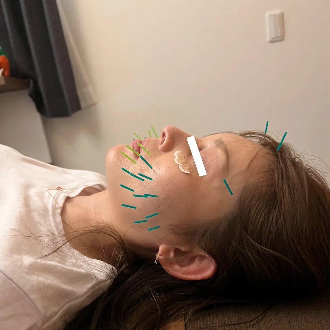 前橋美容鍼　前橋小顔矯正　施術風景