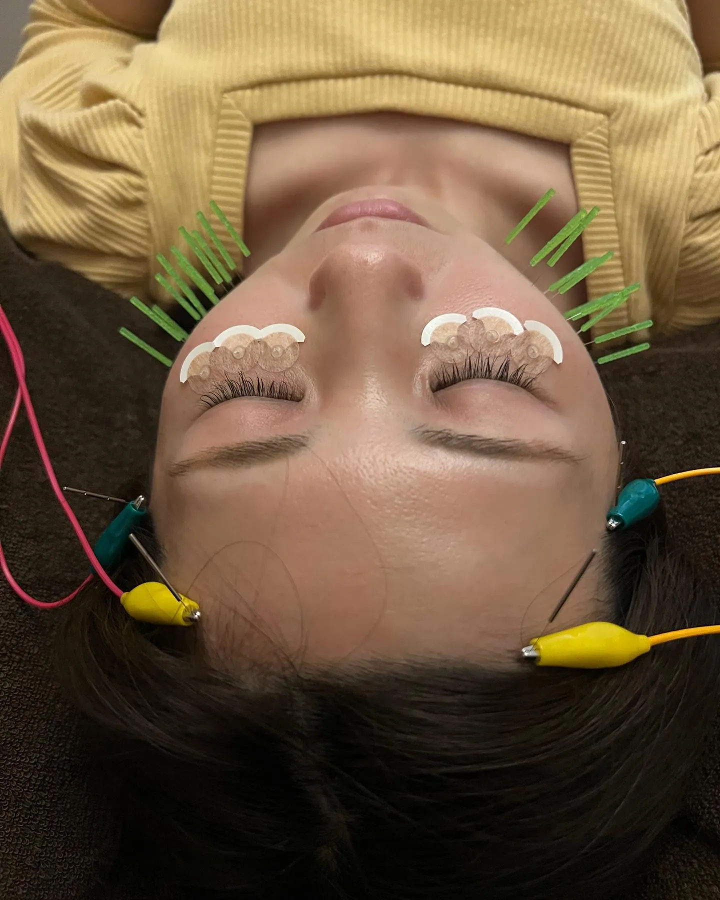 前橋美容鍼　前橋小顔矯正　施術