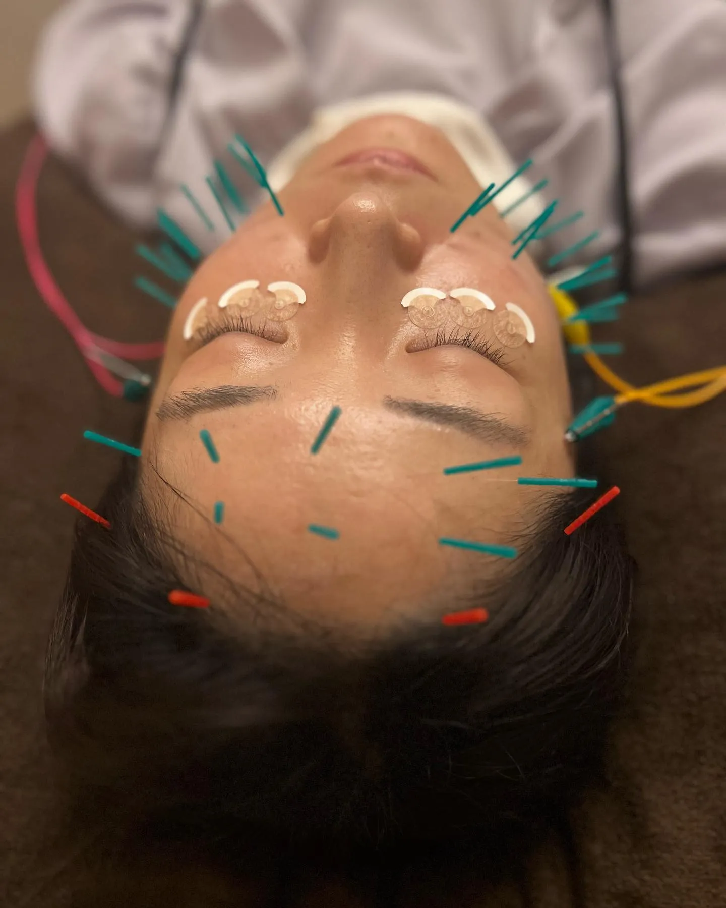 前橋美容鍼　しわ改善