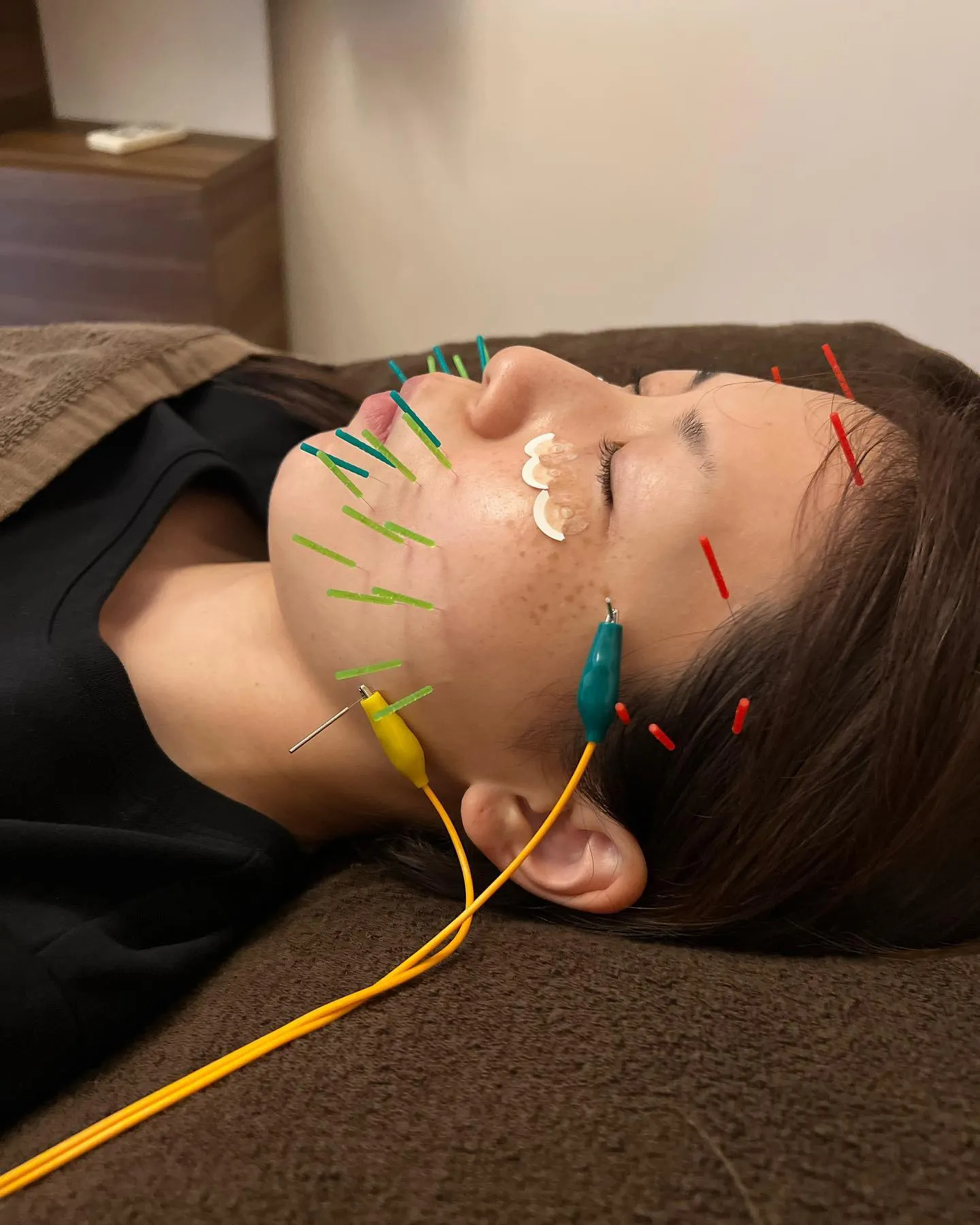 前橋美容鍼　リフトアップ