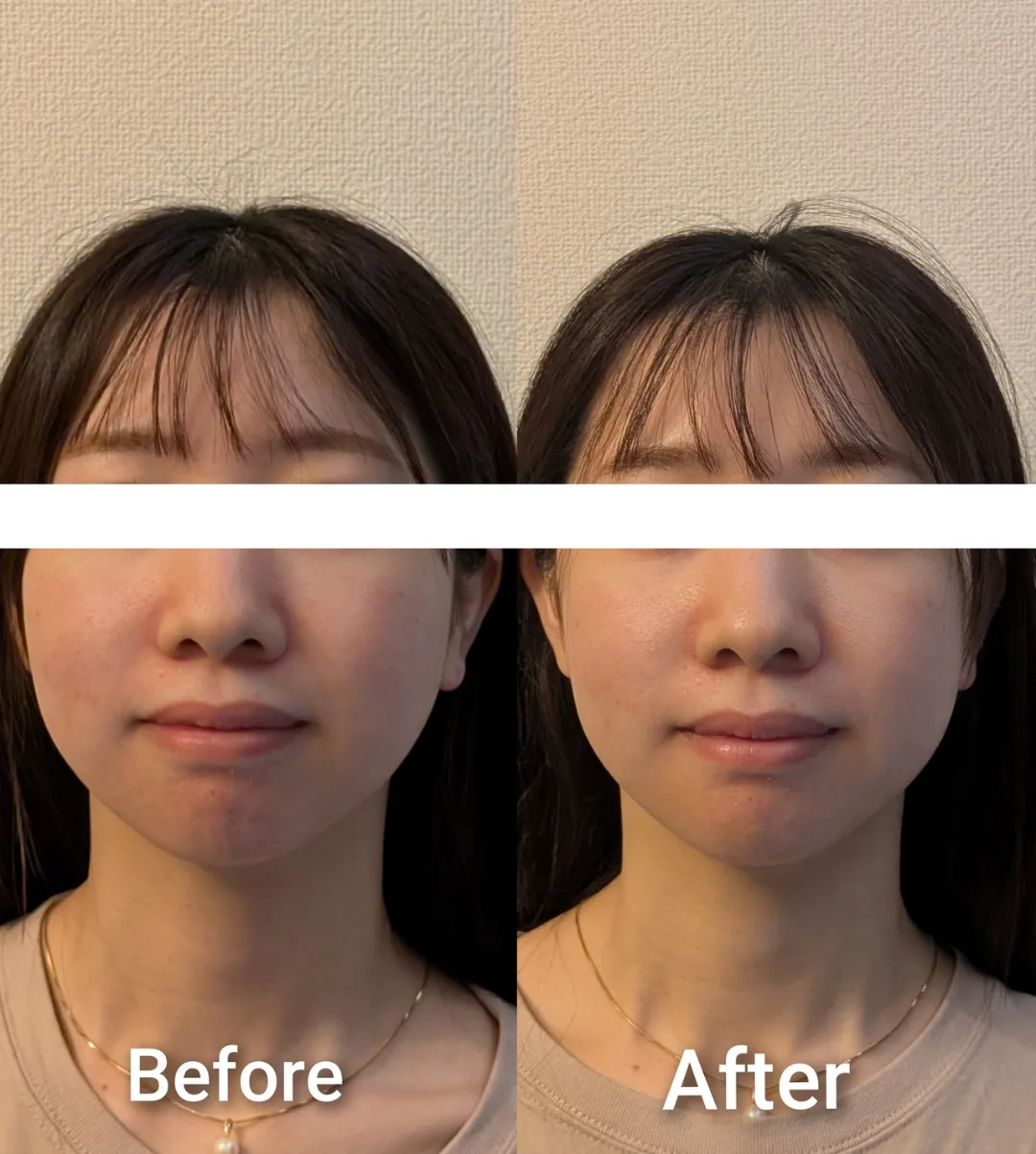 (高崎小顔矯正)ビフォーアフター