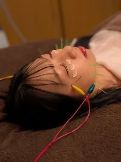 (伊勢崎美容鍼)脱毛後の美容鍼は、3日あけてください