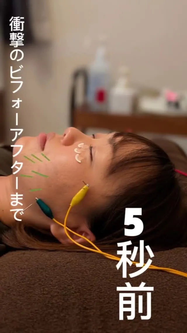 (高崎小顔矯正)NOA式小顔矯正と美容鍼でお悩み解決！